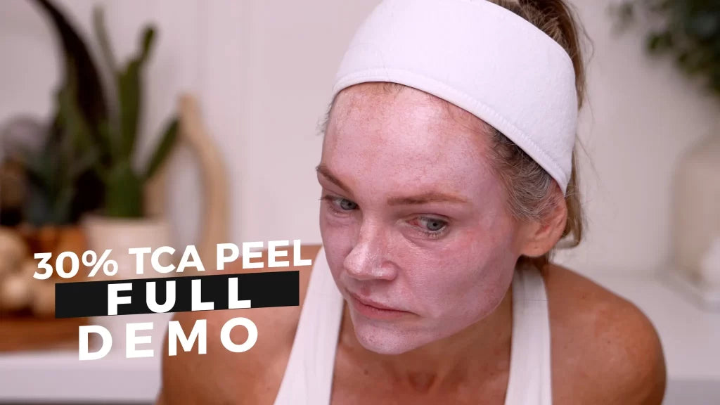 30% TCA Chemical Peel — What No One Shows