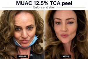 Before and after photographs from an MUAC client using the 12.5% TCA at-home peel